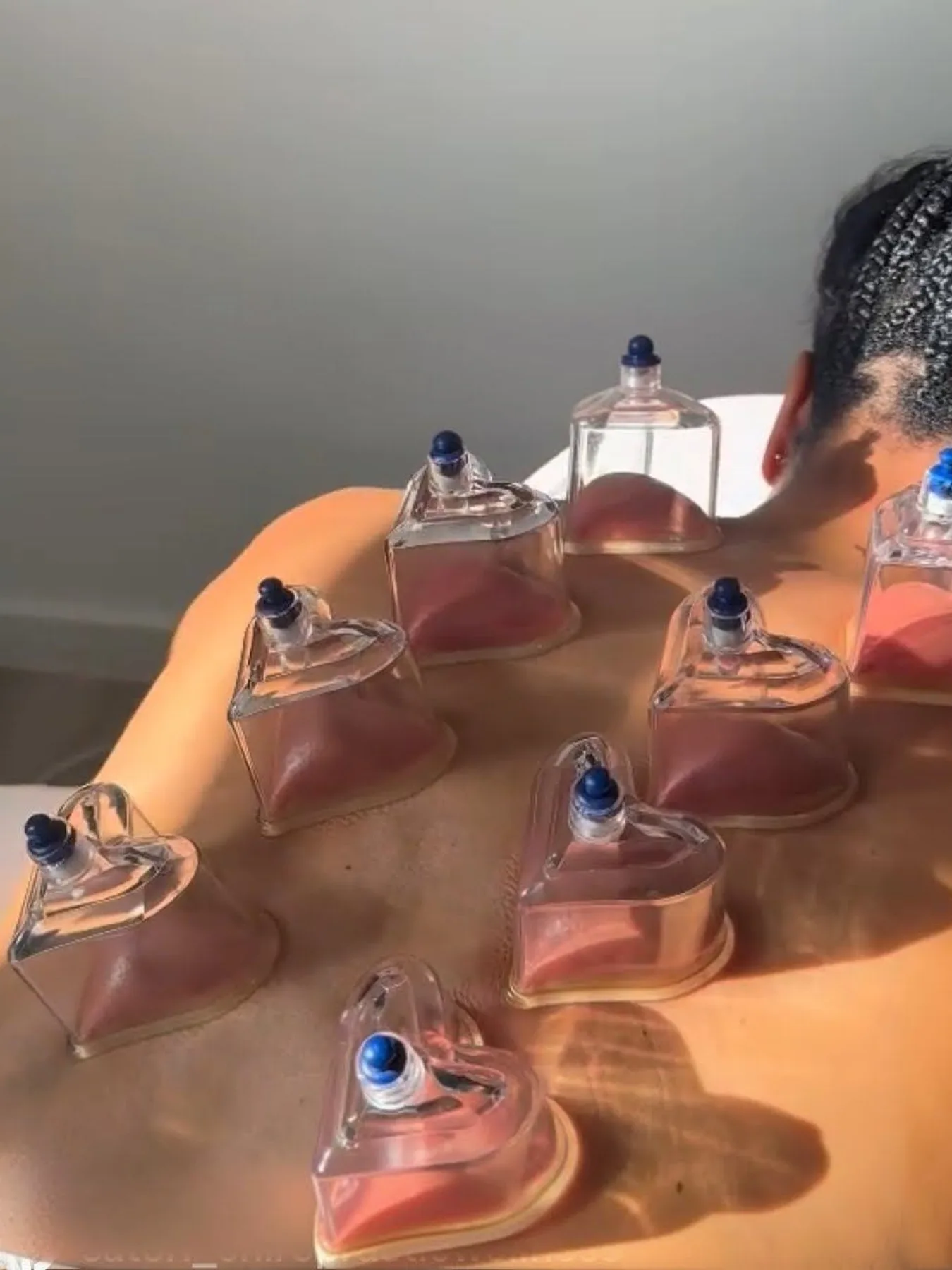 Cupping therapy cups placed across a patient's upper back